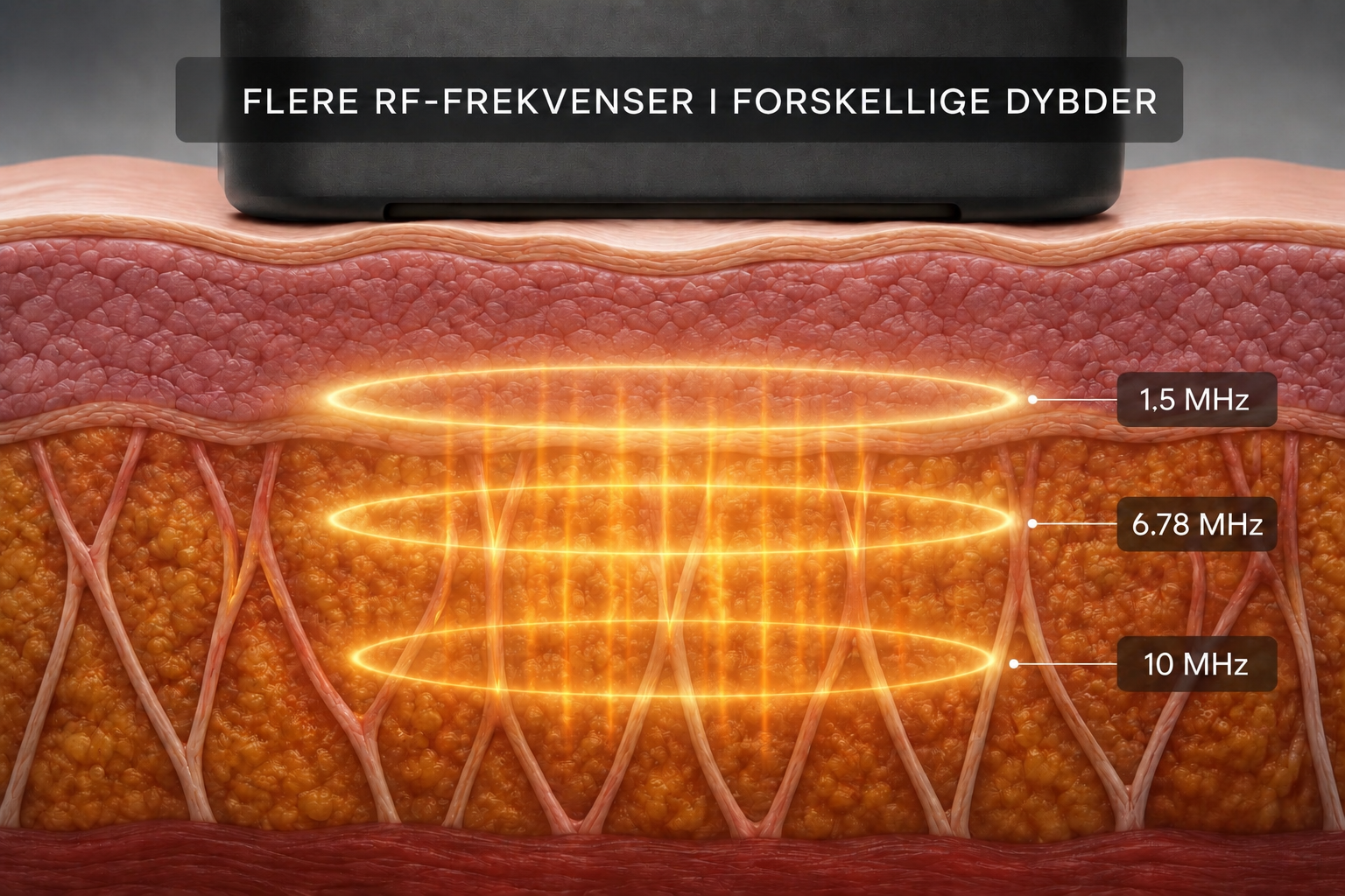 Illustration som visar hur XERF-radiofrekvens arbetar med flera RF-frekvenser på olika djup i huden. Grafiken visar energileverans på 1,5 MHz, 6,78 MHz och 10 MHz som samtidigt värmer olika hudlager och underliggande vävnad. Tekniken stimulerar kollagenproduktion, huduppstramning och hudföryngring genom kontrollerad uppvärmning på flera djupnivåer utan att skada hudytan.